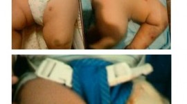 Família denuncia agressão a bebê de 5 meses em berçário de Anápolis-GO
